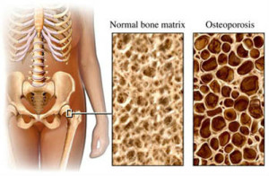 osteoporosis1